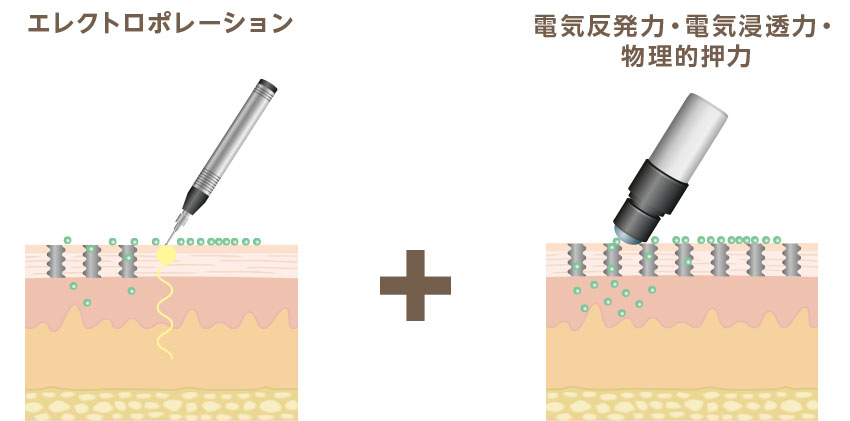 「メソポレーション法」とは