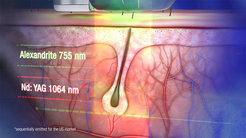異なる2種類のレーザーを同時照射